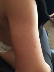 Photo of keratosis pilaris | KPKids.net