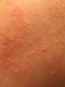 Photos of keratosis pilaris | KPKids.net