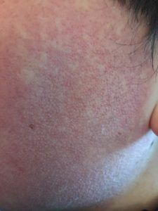 Kids with keratosis pilaris | KPKids.net