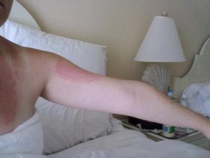 Dermatitis Hives