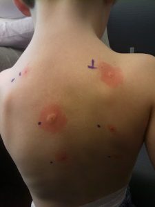 Dermatitis Hives